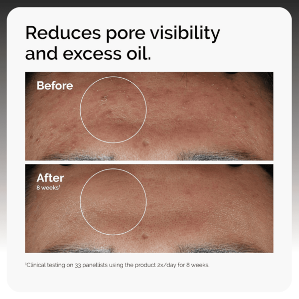 The Ordinary Niacinamide 10% + Zinc 1% 30ml - Image 2